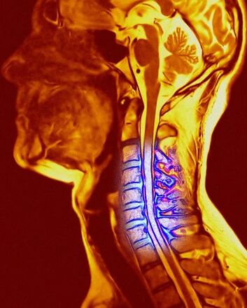 Condrosis cervical