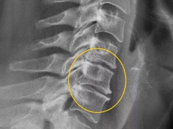 Osteocondrosis de la columna cervical en una raya x