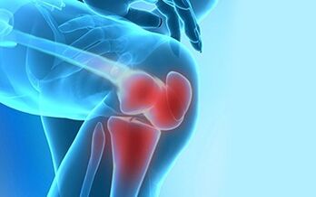 Cómo se manifiesta la artrosis de la articulación de la rodilla