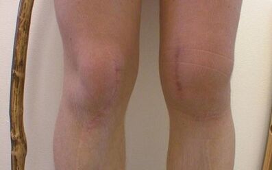 Etapas del desarrollo de la artrosis de rodilla