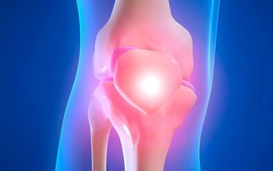 Las razones para el desarrollo de la artrosis de la articulación de la rodilla