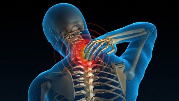 El dolor al girar el cuello puede indicar síndrome vertebral de osteocondrosis cervical