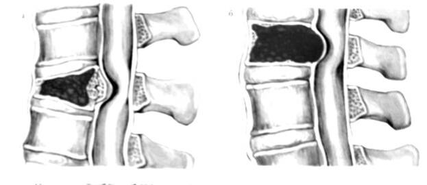 El tumor en la columna es la causa del dolor de espalda