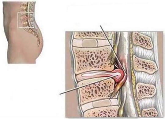 La hernia intervertebral causa dolor de espalda