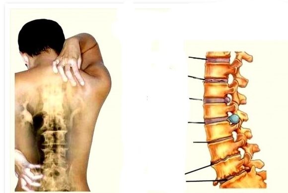 La osteocondrosis es la causa del dolor de espalda