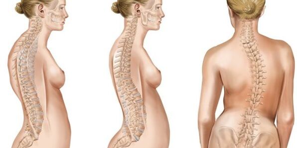 Mezcla de escoliosis de discos intervertebrales